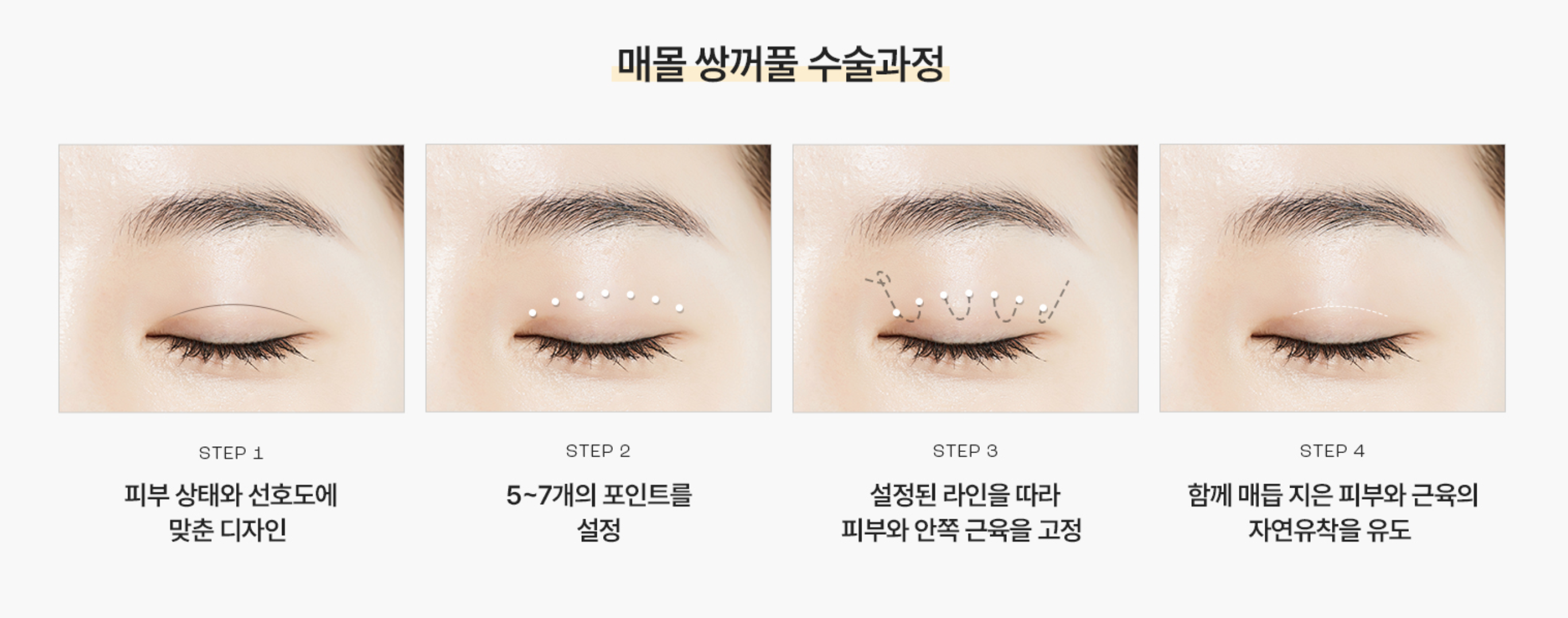 쌍꺼풀 수술 – 매몰법