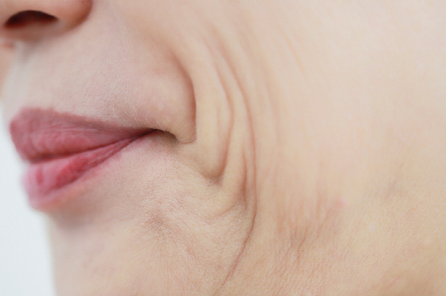 口部皱纹手术(木偶纹矫正)