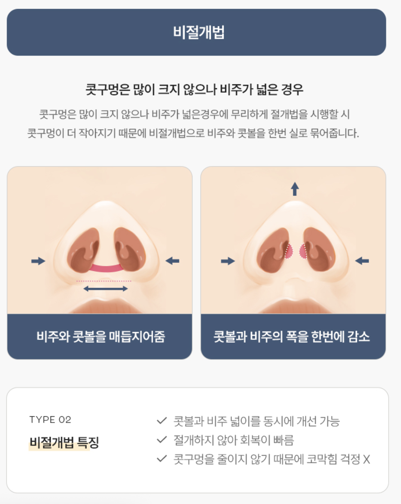 콧방울 축소술 – 비절개법