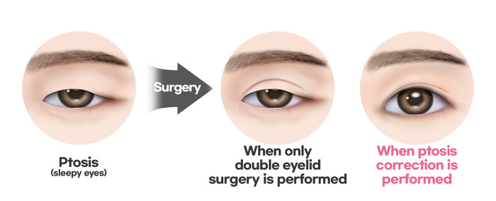 Ptosis Correction Surgery