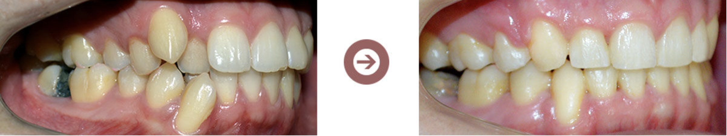 Crowded Teeth Correction