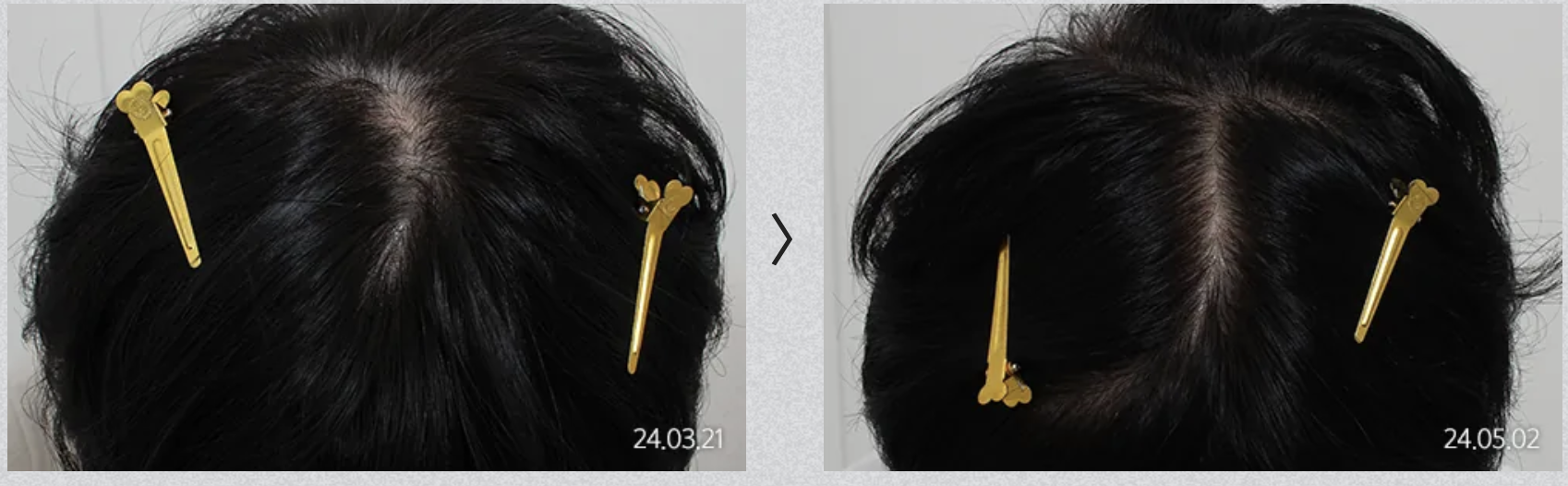 非外科的脱毛治療