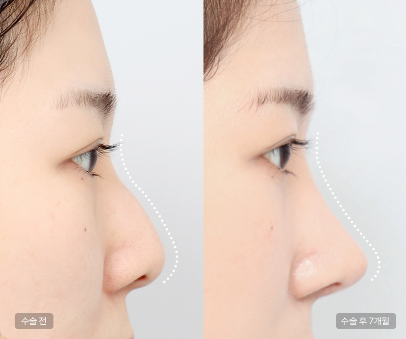 驼峰鼻矫正手术