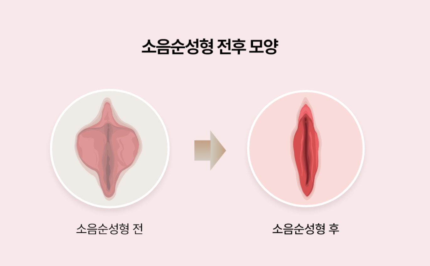 Labiaplasty (Small Labia Surgery)