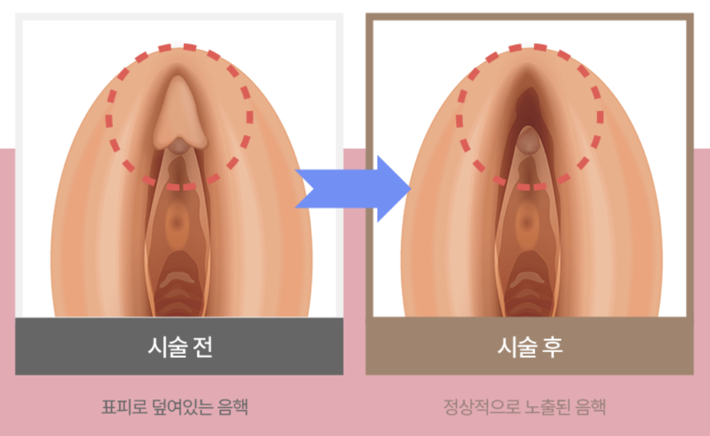 陰唇リフト（大陰唇リフト）