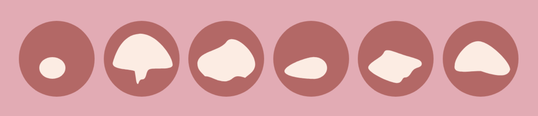 处女膜修补术(处女膜再造手术)