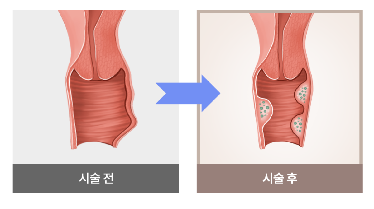 阴道填充剂注射(阴道回春填充剂)