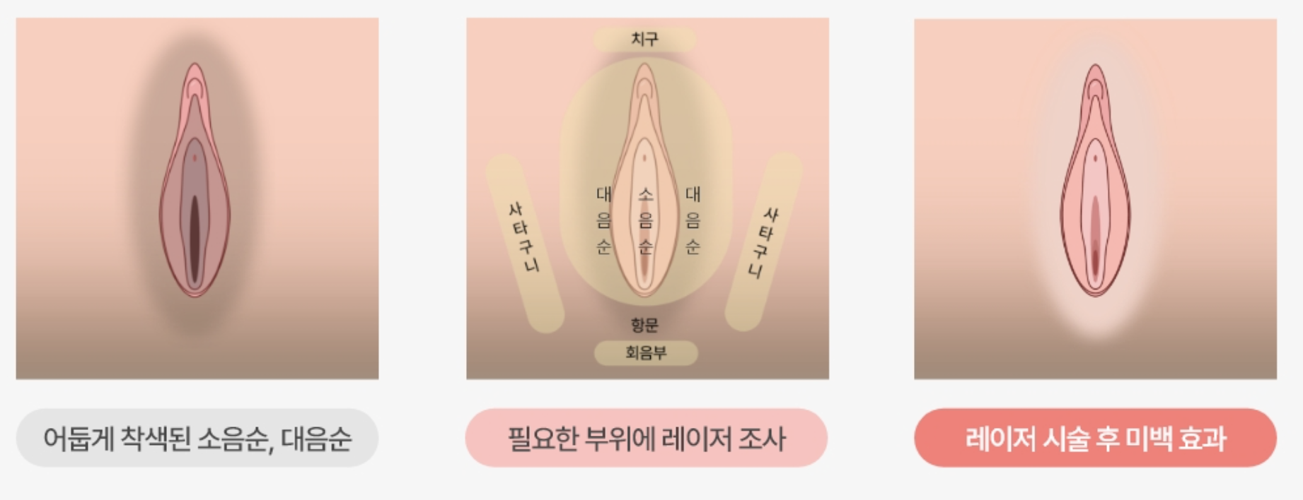 外陰部美白(デリケートゾーン美白レーザー)