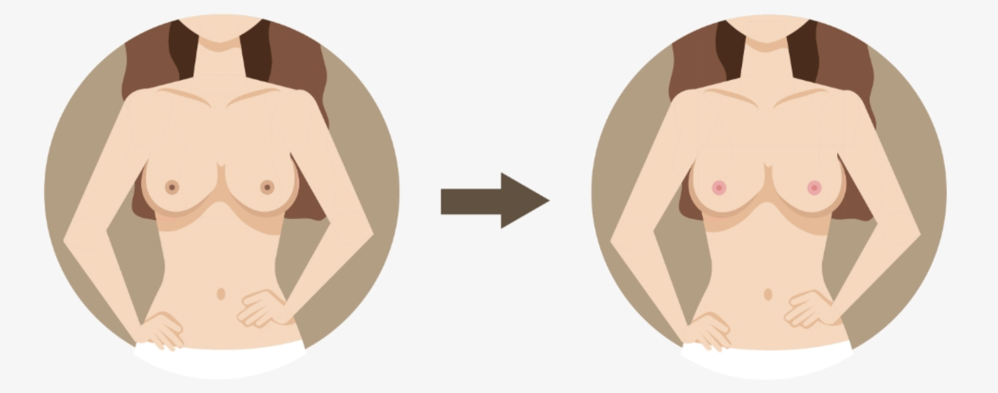 乳晕美白(乳头亮白激光治疗)