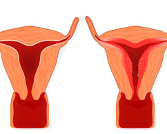 비정상 자궁출혈 (AUB) 관리