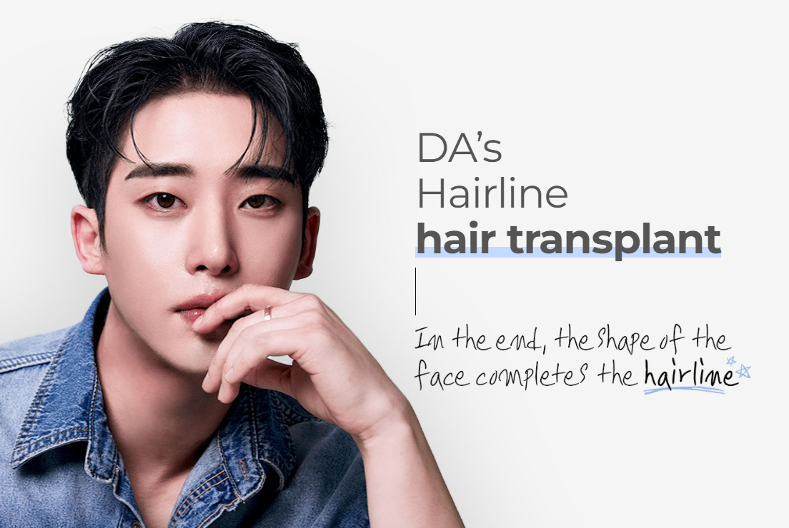 发际线植发