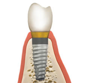 骨移植インプラント