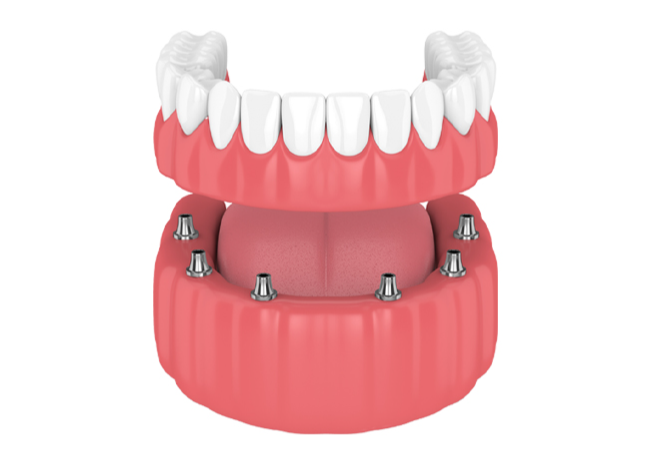 Full Mouth Dental Implant