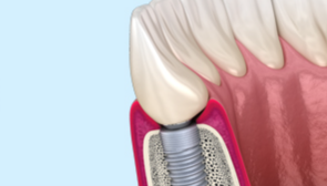 발치 후 즉시 임플란트 식립